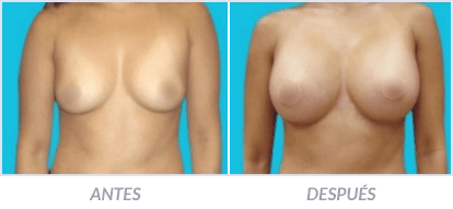 Mastopexia o Levantamiento de mamas